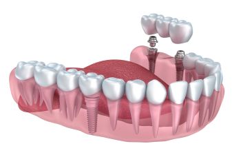 A 3d model of an implant-supported dental bridge