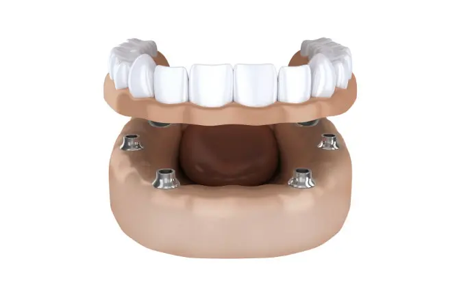 A 3d model of a dental implant.