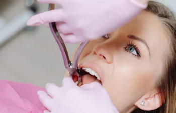 Close-up of root canal procedure in Acworth showing dental precision care